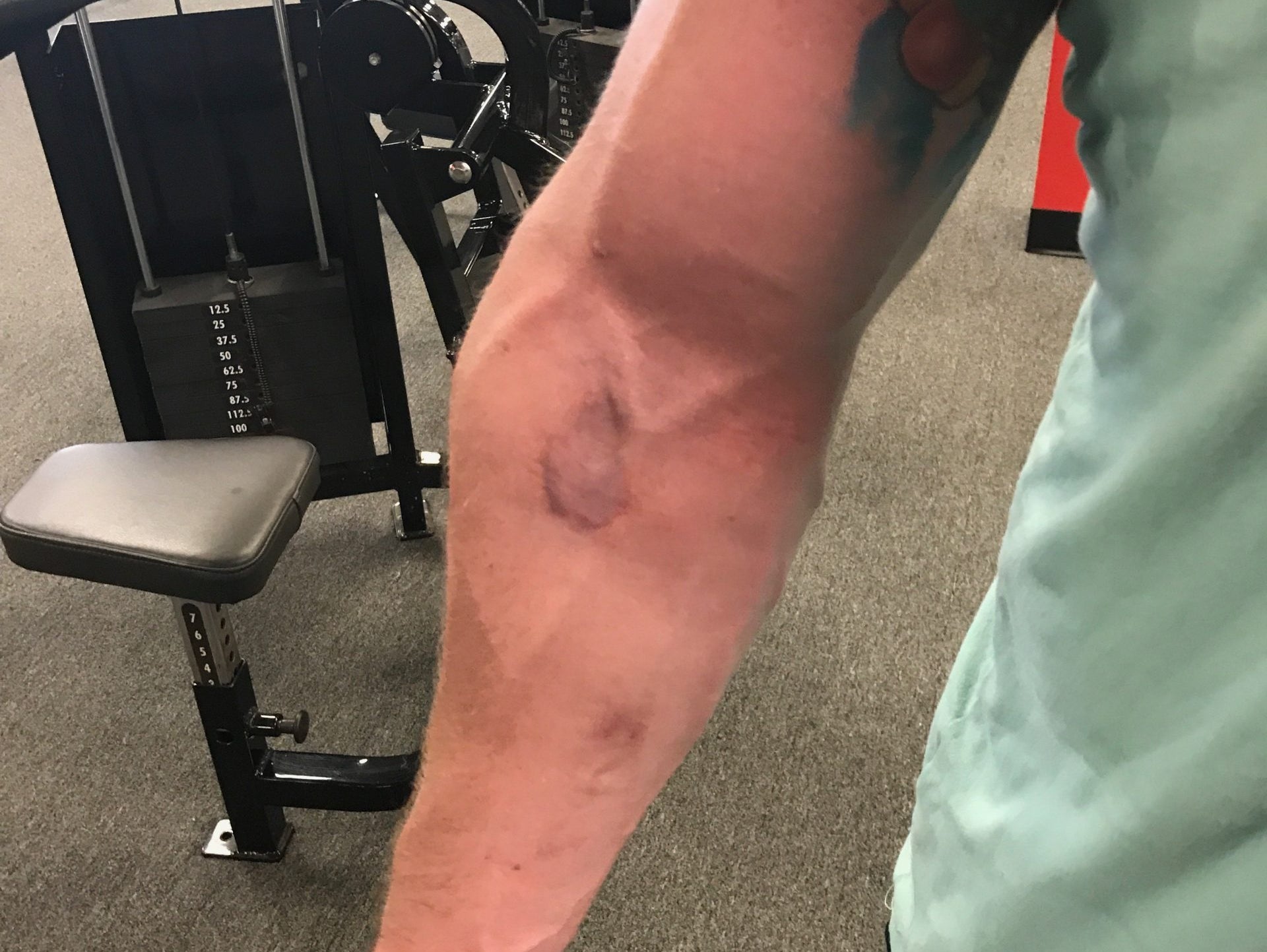 Strongman Patient (Biceps Repair)