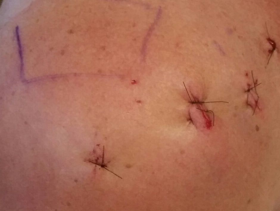 6 Months Post Shoulder Surgery Update! (w/video's)