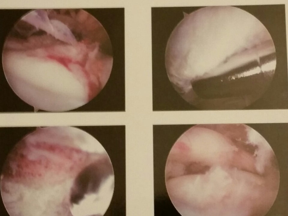 An Inside View Of My Torn Rotator Cuff !