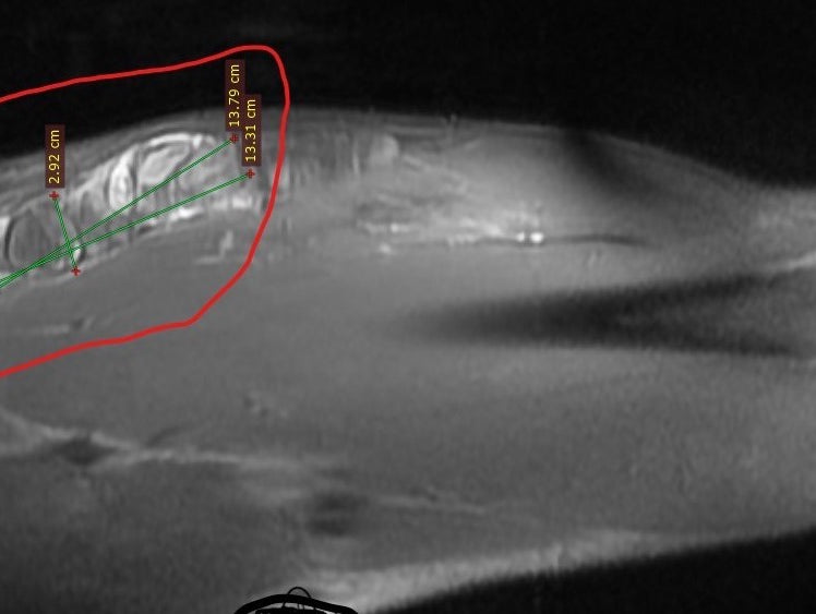 Diagnosis Of My Hip and Leg