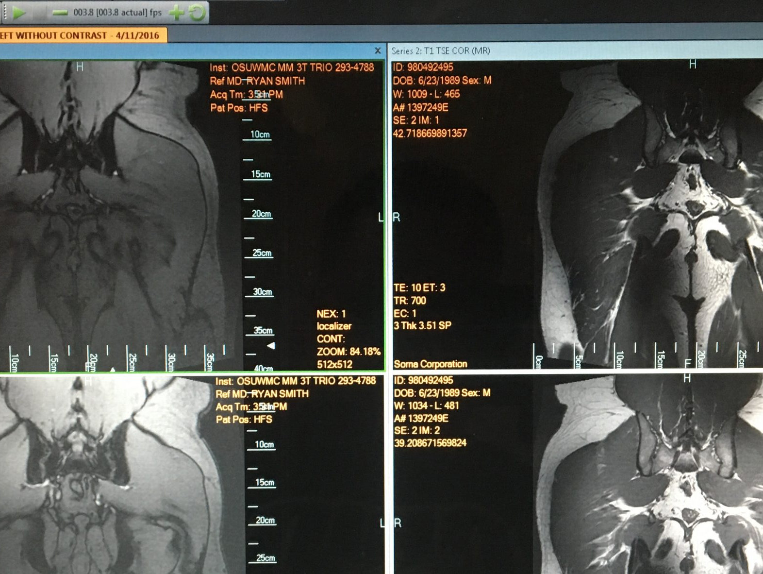Appointment with Hip Specialist / Future Hip Replacement? / & the Return to Competing Raw
