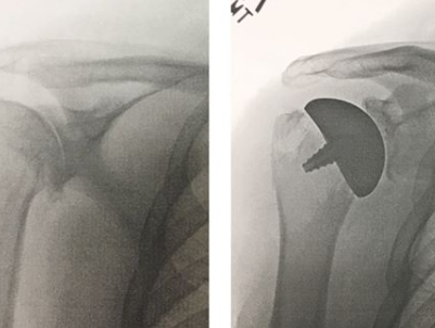 My own Price of the Platform- Shoulder Replacement
