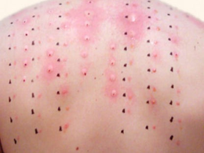 4/5- A trip to the Allergist, and some benching