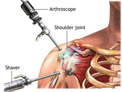 Post Surgery Update w/ Rehab Protocol .PDF