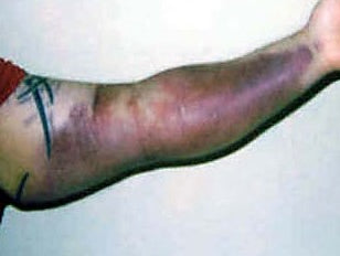 WHERE BAD FORM AND HEAVY WEIGHTS COLLIDE