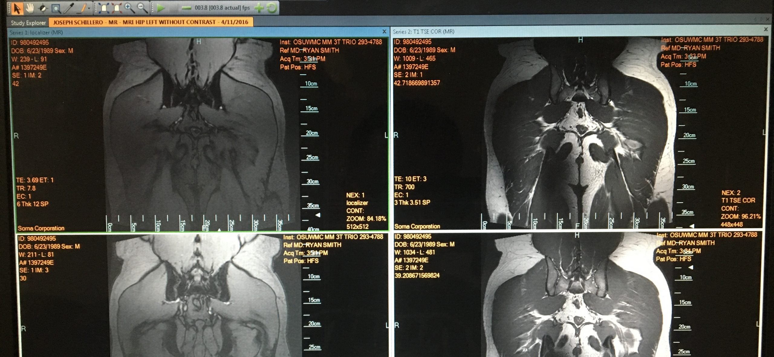 Appointment with Hip Specialist / Future Hip Replacement? / &amp; the Return to Competing Raw