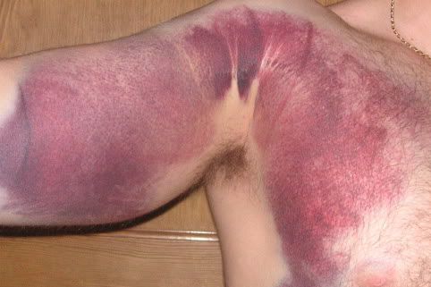 Pec Strain