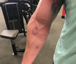 Strongman Patient (Biceps Repair)